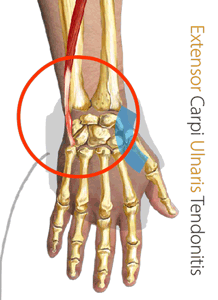 EXTENSOR CARPI ULNARIS TENDINITIS